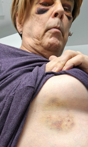 Image of underboob bruise from domestic assault